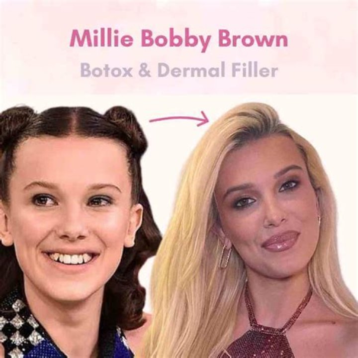 Has Millie Bobby Brown Done Lip Filler? Fans Suspect Botox And Nose Job!