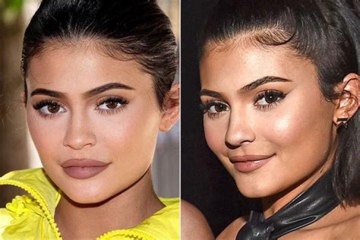 Kylie Jenner claims she’s let her lip fillers ‘dissolve’… but does it happen overnight??